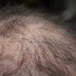 hair loss after surgery