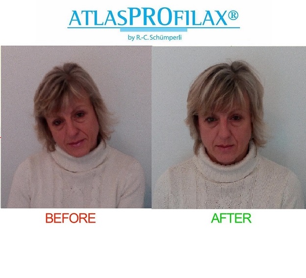 Before and after AtalsPROfilax 2